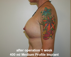 plastic-surgery-breast-augmentation
